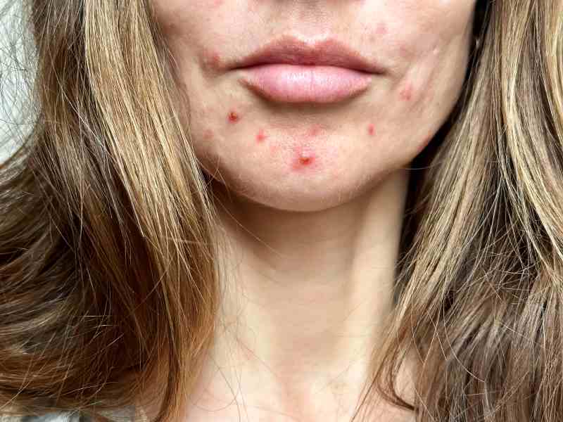 Entenda porquê a acne pode voltar na vida adulta e como cuidar da pele