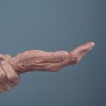 Nova terapia aprovada pela Anvisa reacende debate sobre tratamento do Parkinson avançado