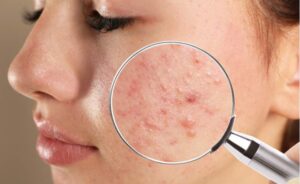 Rosto com acne Divulgacao
